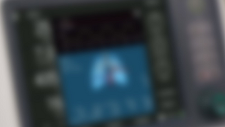 A blurred image of a hospital monitor screen
